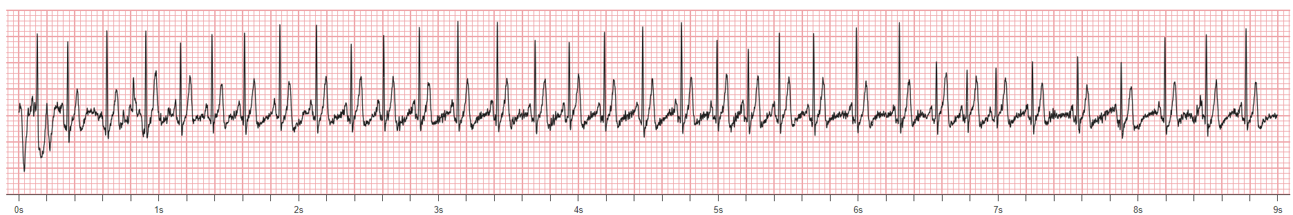 Incarta Biobeat rhythm strip plugin